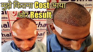 HAIR TRANSPLANT BEST RESULTS AND COST INDIA  ONE MONTH RESULTS [upl. by Ayerhs961]