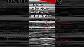 Fetal Heart Rate Pro Tip pocus ultrasound emergencymedicine obgyn pregnancyultrasound [upl. by Alle52]