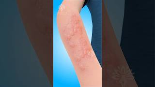 Hives What Happens Inside Your Body 😮 shorts urticaria  Creativelearning3d [upl. by Ehudd]