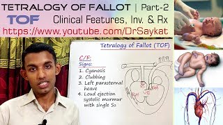 Tetralogy of Fallot TOF  Part 2  Clinical features Investigations amp Treatment  Dr Saykat [upl. by Auqenes]