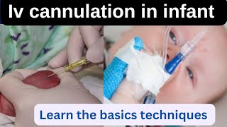 iv canula procedure in childreninfant different techniques iv canula pass in infantchildren [upl. by Donalt]