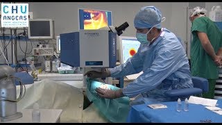 La chirurgie au laser en ophtalmologie du CHU Angers [upl. by Tihw]