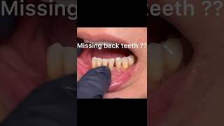 Missing back teeth  Implants expensive Dislike partial dentures [upl. by Sil]