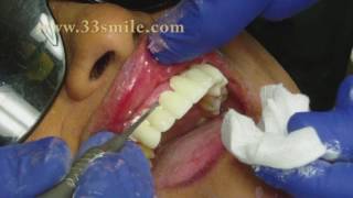 Dental Crowns and Bridges Procedure at Cosmetic Dental Associates in San Antonio TX [upl. by Eyatnod]