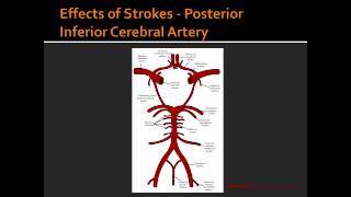 Effects of Strokes  Posterior Inferior Cerebral Artery [upl. by Plume]