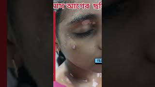 Vitiligo treatment safeed daag ka ilajBefore After result Just 1 monthhair regrowth 9734984030 [upl. by Kaia]