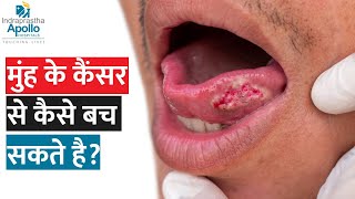 How Do We Diagnose Oral Cancer Quickly  Dr Anil D Cruz  Apollo Hospital [upl. by Ahsekahs]