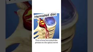 Herniated disc shorts mbbs femalereproductivesystem pregnancy [upl. by Allemrac]