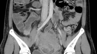 GU C10 Post partum PID [upl. by Sharp]