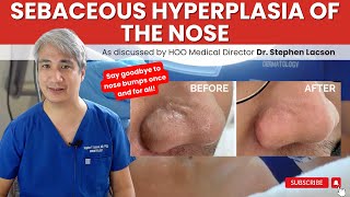 DERMATOLOGIST EXPLAINS HOW TO TREAT NOSE BUMPS DUE TO SEBACEOUS HYPERPLASIA [upl. by Gaspar]