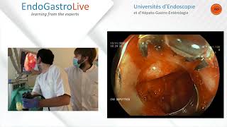 Hemostase endoscopique dun ulcère duodénal hémorragique [upl. by Norling]