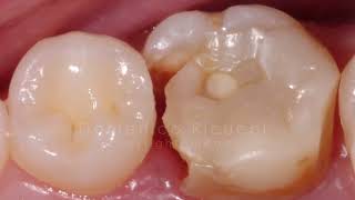 Preendodontic buildup in the retreatment of a mandibular molar [upl. by Sacksen]