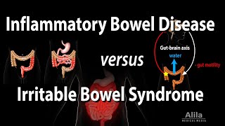 Inflammatory Bowel Disease vs Irritable Bowel Syndrome Animation [upl. by Micah]