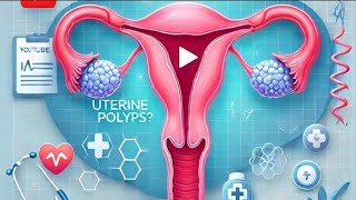 what you know about uterine polyps and how it affects you from being pregnant  Hong Kong China [upl. by Starling]