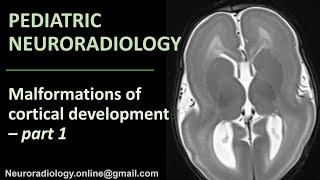 Pediatric Neuroradiology  Malformations of Cortical Development part 1 [upl. by Adnilre35]