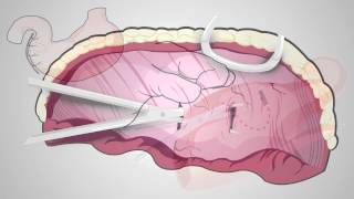 Skills Laboratory How to perform a beltloop gastropexy [upl. by Eirena]