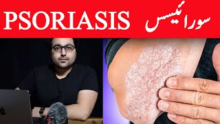 Dr ZeePsoriasis Treatment – The Best 3 Remedies for Psoriasis  सोरायसिस [upl. by Rees831]