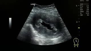 Endometrial carcinoma ultrasound [upl. by Nilats]