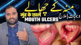 Mouth Ulcers  Munh Men Chale Kyun Hote Hain  Munh Mein Chhale Ka Ilaj  Dr Aqeel Maqsood [upl. by Latsyrhk971]