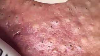 Blackheads amp Whiteheads Satisfying Removal 0275 [upl. by Ekez164]