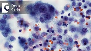 What is Cytopathology What are the different types of Cytology test  Dr Sanjeev Katti [upl. by Aoket855]