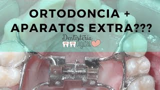 ORTODONCIA  APARATOS EXTRA Para qué sirven [upl. by Yttak809]