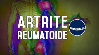 ARTRITE REUMATOIDE  SÉRIE SAÚDE BRASIL [upl. by Ymmik]