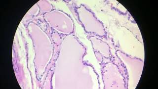 Papillary Carcinoma Thyroid gland Histopathology [upl. by Egon665]