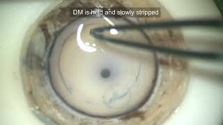 Descemet Membrane Endothelial KeratoplastyDMEK Preparation of Donor cornea [upl. by Niasuh185]