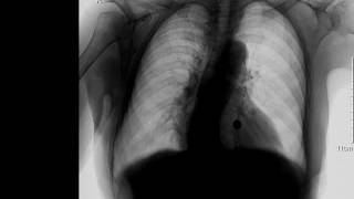 CASE 231 unilateral hypertranslucent left hemithorax X RAY [upl. by Nesaj]