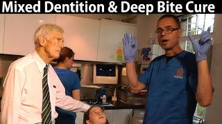 Orthotropics Case Assessment for Deep Bite Correction During Mixed Dentition Period by Dr Mike Mew [upl. by Sully]