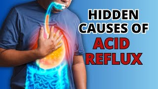 5 Hidden Causes of Acid Reflux You Need to Know [upl. by Akirre]