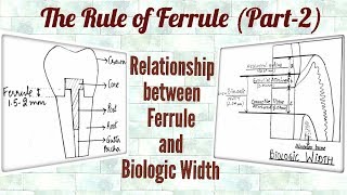 Ferrule Effect Part2 Relationship between Ferrule and Biologic Width [upl. by Eened600]