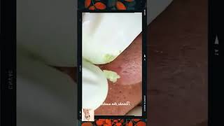 Blackheads Removal  Acne Treatment and Very Satisfying Satisfying Pimple pop blackheads [upl. by Sirois]