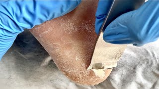 Feet callus removalampfoot scraping dead skin【Xiao Yan Pedicure】 [upl. by Huttan]