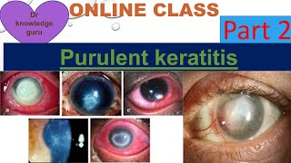 Purulent keratitis keratitis part 2 [upl. by Ungley144]