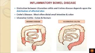 Inflammatory bowel disease pathogenesis  DrVShanthi [upl. by Largent]