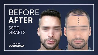 Hair Transplant Result at Cosmedica  Dr Acar [upl. by Rosita]