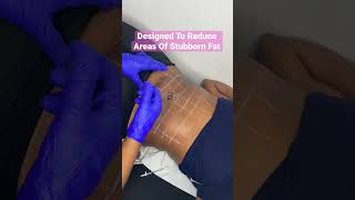 Fat Dissolving Injections  How To Reduce Stubborn Fat  Noninvasive Technique [upl. by Flavius]