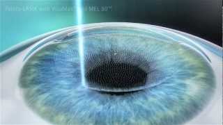 Montpellier opération laser LASIK myopie Docteur Coullet [upl. by Tanberg]