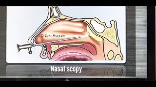 Acute nasopharyngitis English Patient teaching programme [upl. by Leopoldeen581]