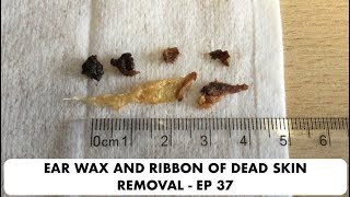 RIBBON OF DEAD SKIN AND EAR WAX REMOVAL  EP 37 [upl. by Stephania]