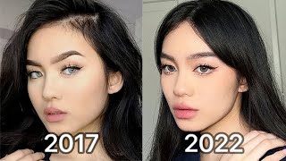 How I Changed My Face lip injections amp botox after 5 years [upl. by Nannah]