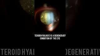 Asteroid hyalosis [upl. by Fergus]