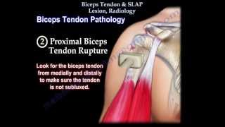 Biceps Tendon amp SLAP Lesion Radiology  Everything You Need To Know  Dr Nabil Ebraheim [upl. by Connett107]