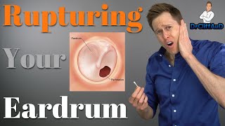 Ruptured Eardrum  Tympanic Membrane Perforations [upl. by Siward]