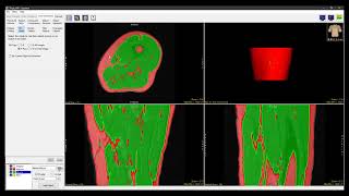 Analyze 150  Segment Using Fill Holes to Segment Objects [upl. by Rosenblast220]