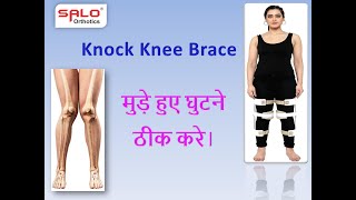 Knock Knee kaise Thik Kare  Salo Orthotics Knock Knee Problem Solution Brace Genu Varum Deformity [upl. by Sivie]