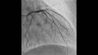 CRUSH TECHNIQUE STENTING OF LAD  D1 BIFURCATION [upl. by Nicolau416]