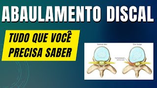 Abaulamento Discal  O que você precisa saber [upl. by Trip]